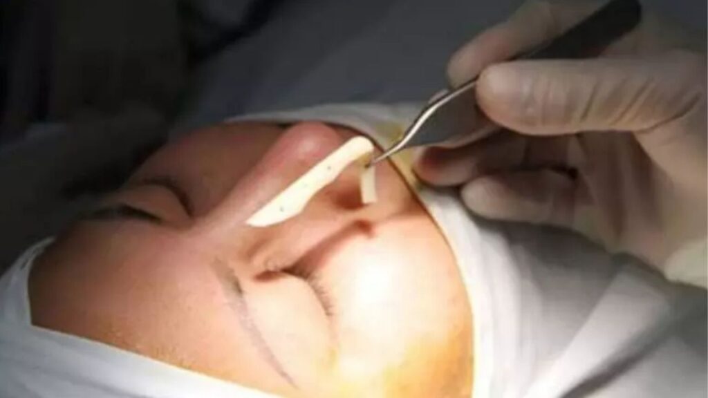 Tháo sụn mũi khi nào cần? 6 dấu hiệu, quy trình và chăm sóc sau tháo