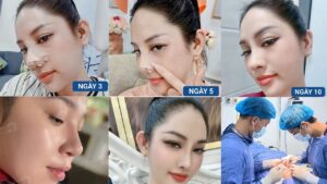 Thời gian hồi phục sau nâng mũi: Bao lâu thì lành và đẹp tự nhiên