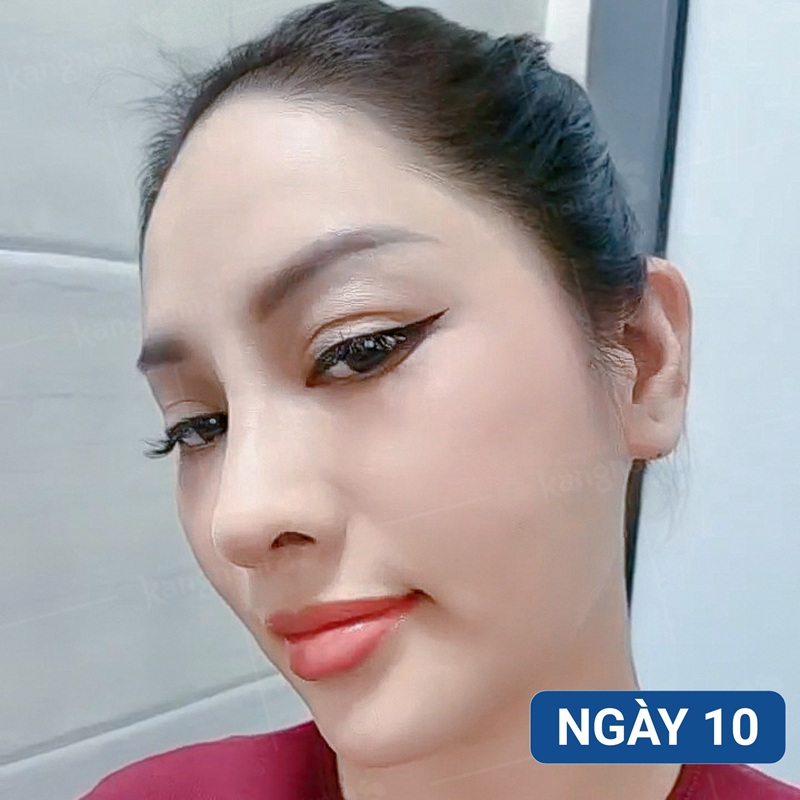 Mũi bắt đầu gom dần, giảm sưng đau