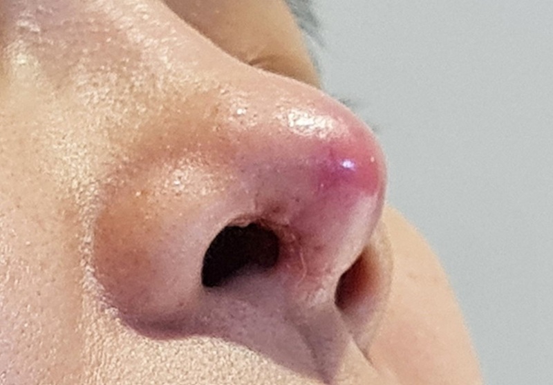 Mũi sưng đỏ, đau nhức kéo dài