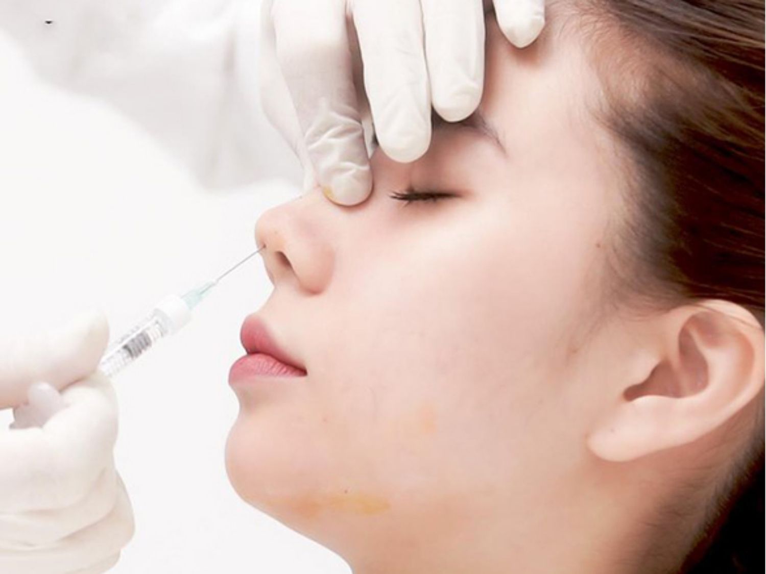 Tiêm filler nâng mũi khi cho con bú có nhiều rủi ro