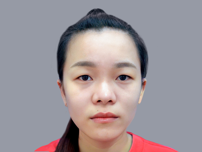 Mắt không rõ mí nên cân nhắc cắt mí