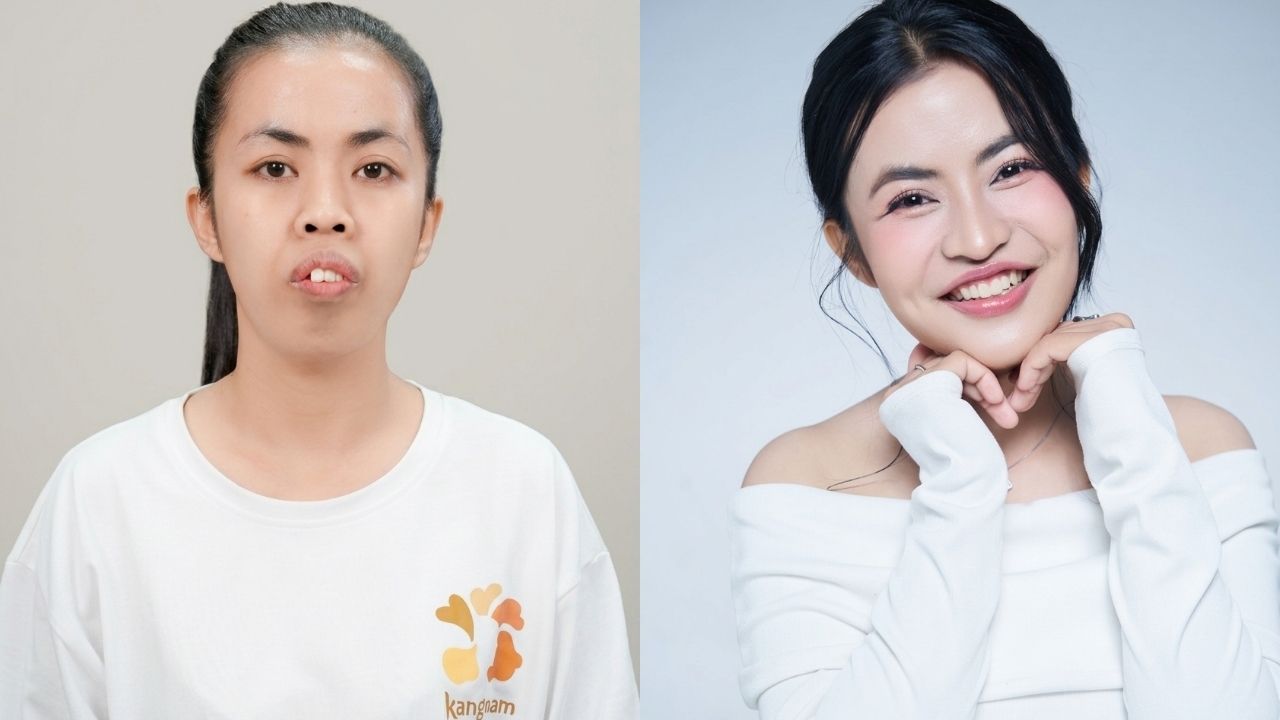 Hình ảnh của Trà My trước và sau khi được chỉnh hàm hô và trượt cằm