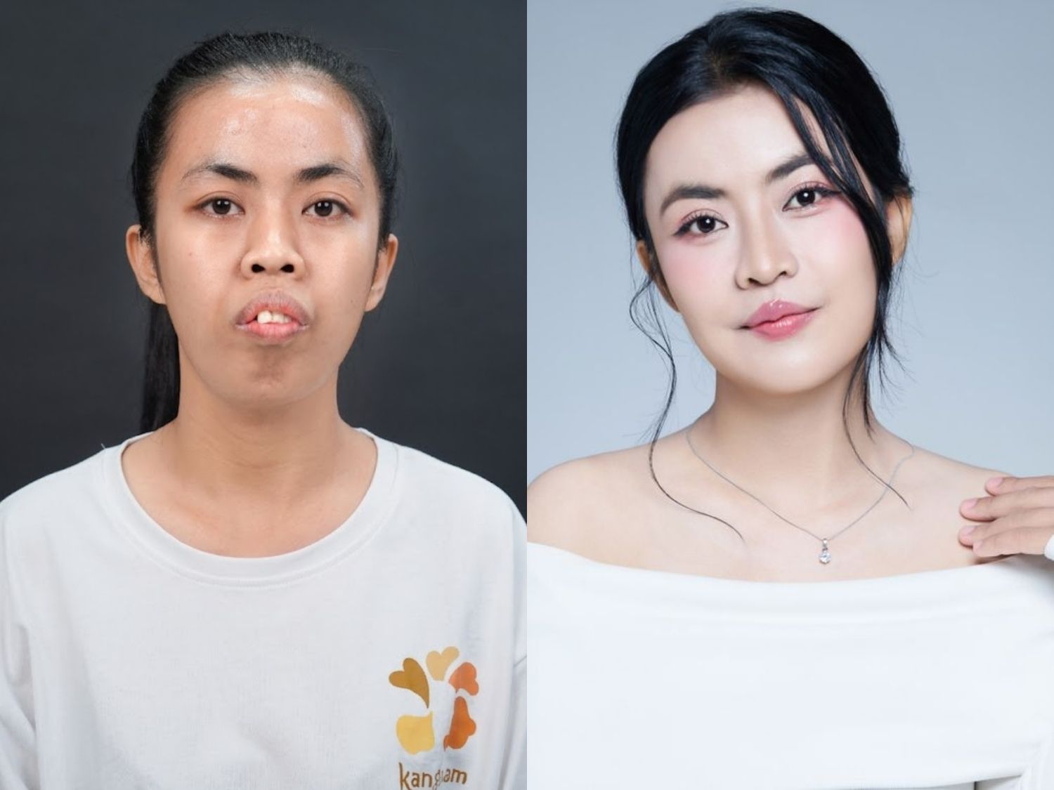 ảnh trước và sau khi cắt mí, chỉnh hàm, nâng mũi, cấy mỡ của trà my