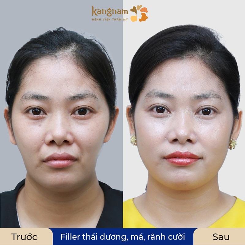 Da căng mịn và đầy đặn hơn