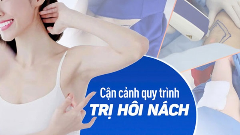 Quy trình trị hôi nách tại Kangnam TPHCM
