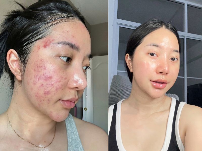 Trị mụn hiệu quả, an toàn