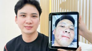 Trị mụn ở đâu đẹp tại Sài Gòn? Cách so sánh các cơ sở trước khi lựa chọn