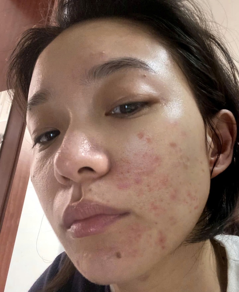 Mụn tái phát và mọc nhiều hơn