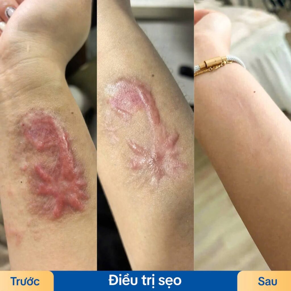 Các loại sẹo phổ biến hiện nay