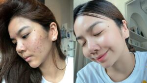 Trị sẹo ở đâu đẹp tại Sài Gòn? 4 tiêu chí chọn địa chỉ uy tín