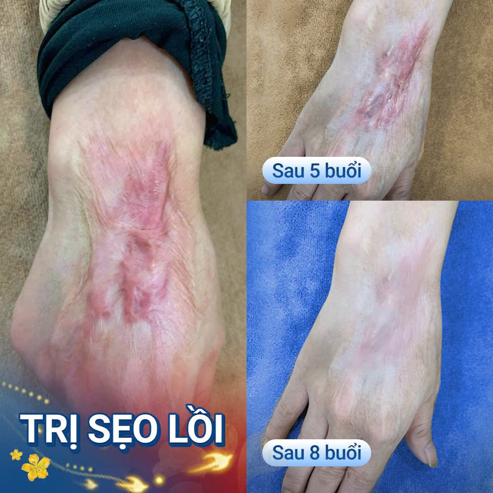 Trị sẹo lồi tại Kangnam sẽ có sự thay đổi rõ rệt sau 1 liệu trình