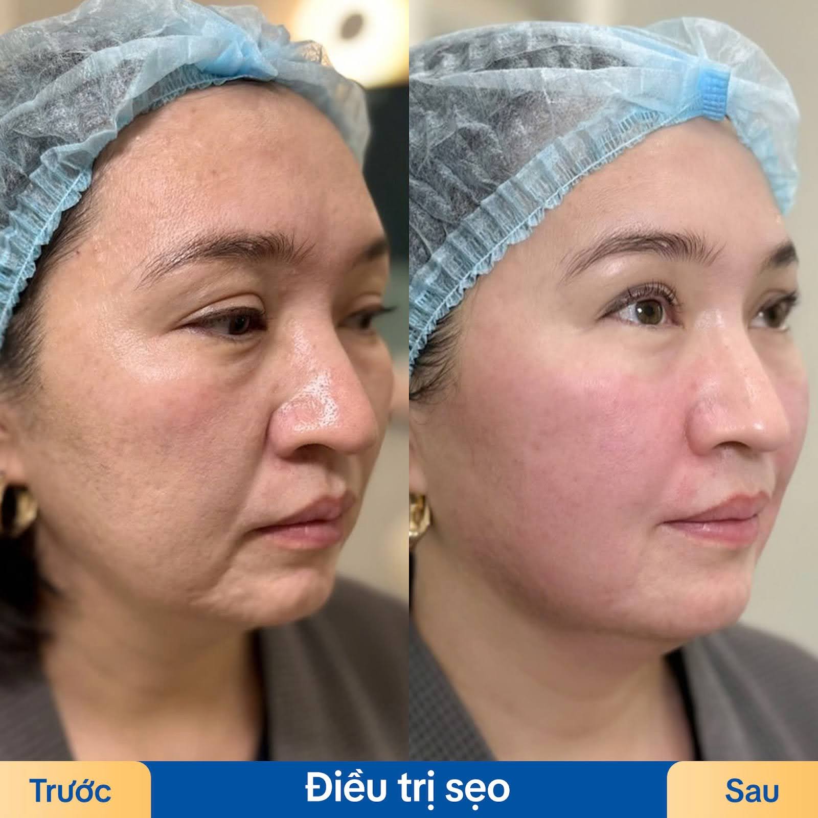 Phác đồ trị sẹo tại Kangnam TPHCM được xây dựng cá nhân hoá