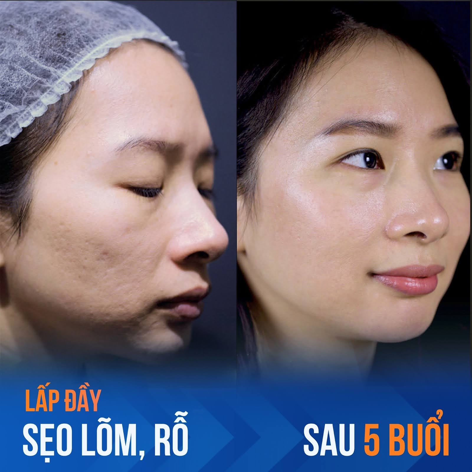 Ứng dụng laser để lấp đầy làn da sẹo rỗ