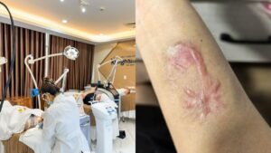 Trị sẹo tại Kangnam TP.HCM – Giải pháp điều trị sẹo an toàn, cải thiện rõ rệt