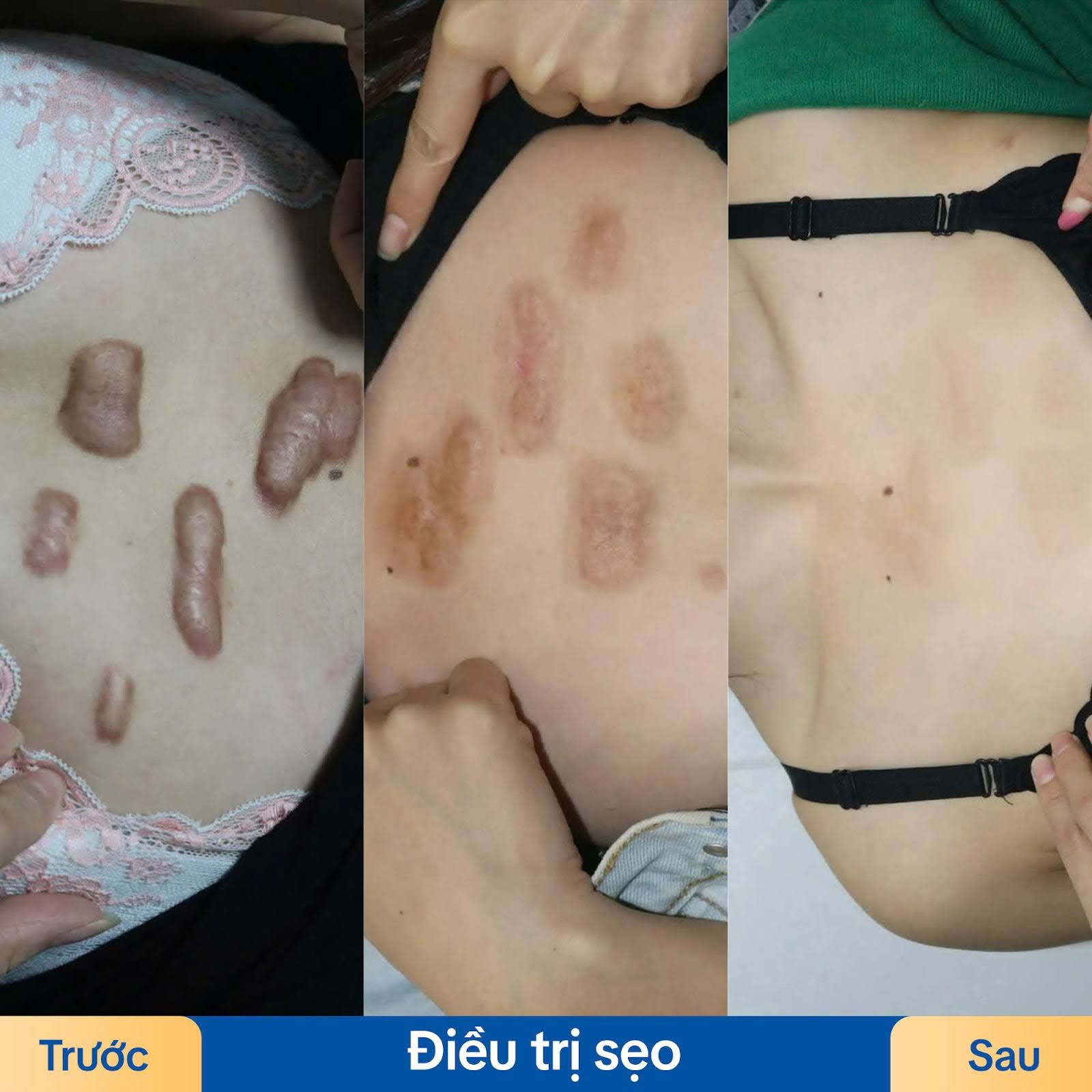 Sẹo lồi phì đại, lâu năm thay đổi rõ rệt sau trị sẹo tại Kangnam