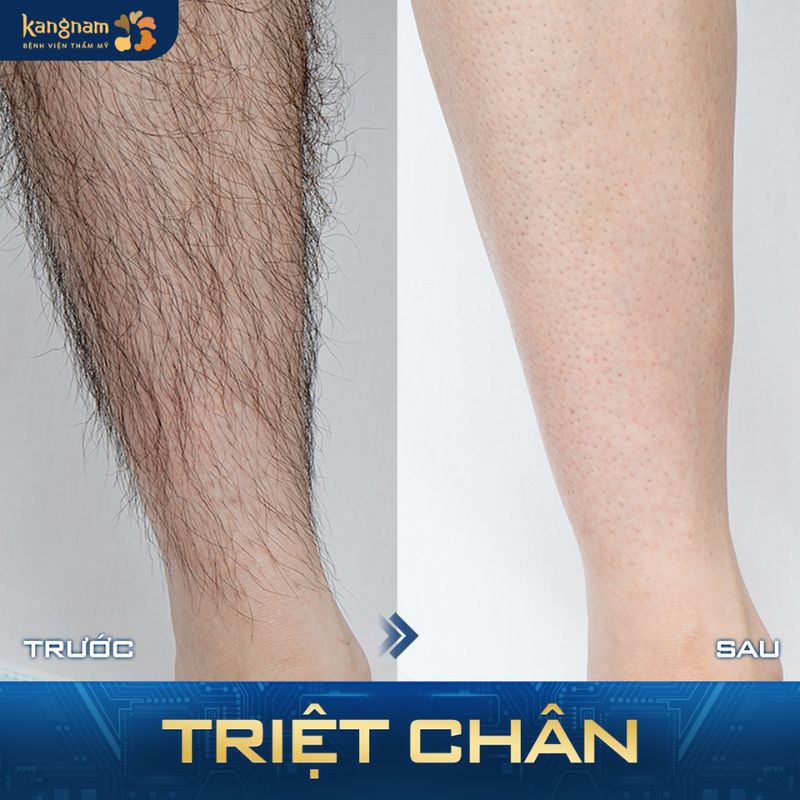 Triệt sạch lông chân, không hại da