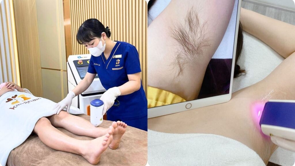 Triệt lông tại Kangnam TP.HCM – Giải pháp triệt lông an toàn, hiệu quả lâu dài