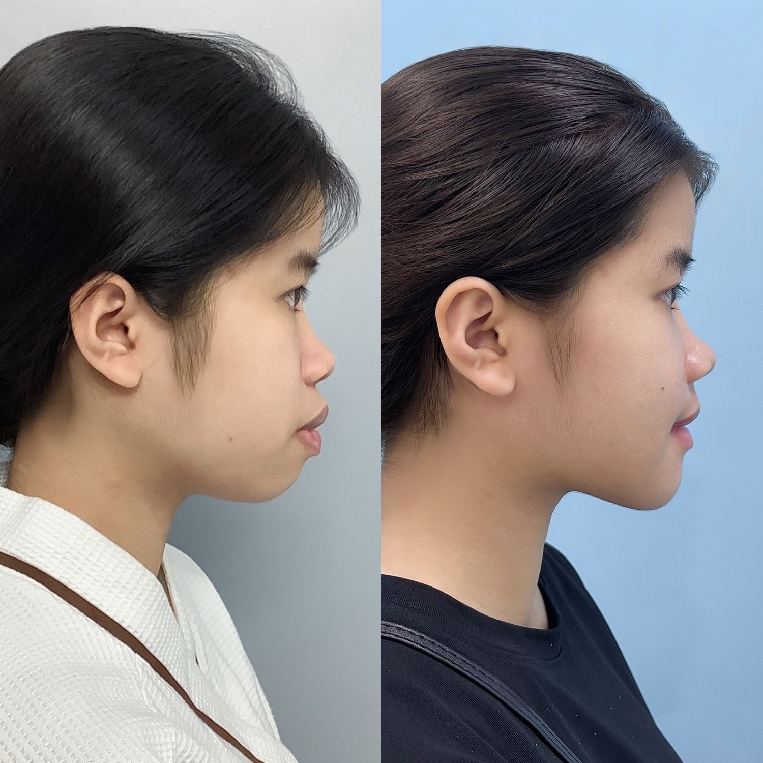 Nhiều khách hàng chọn sửa cằm tại các cơ sở thẩm mỹ lớn ở Sài Gòn