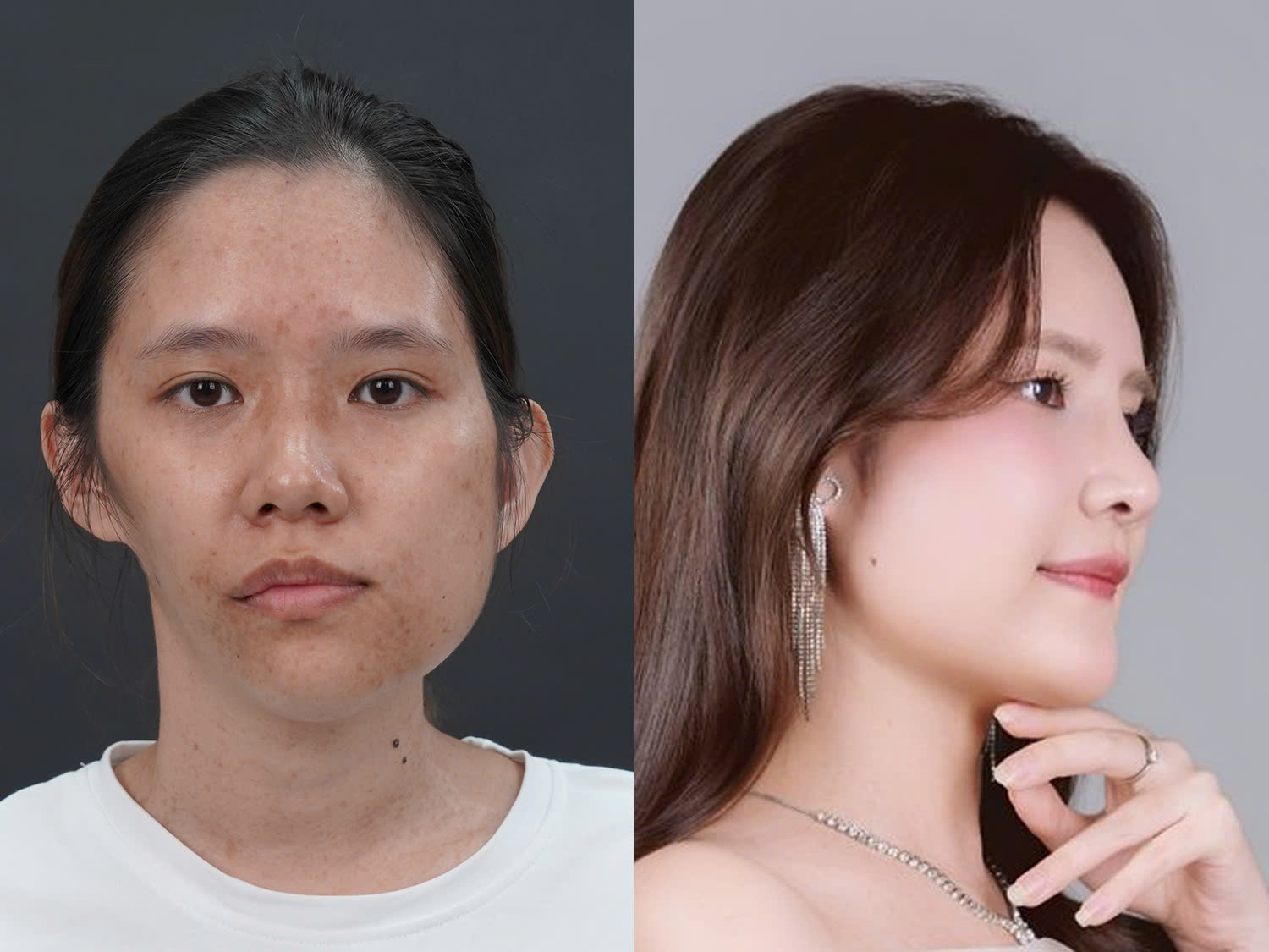 Võ Trần Bảo Ngọc trước và sau khi chỉnh hàm, nâng mũi, gương mặt cân đối và hài hòa