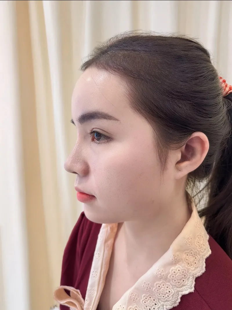 Khách hàng Kim Hạnh nâng mũi tại Kangnam sở hữu dáng mũi tự nhiên, đẹp theo mọi góc nhìn