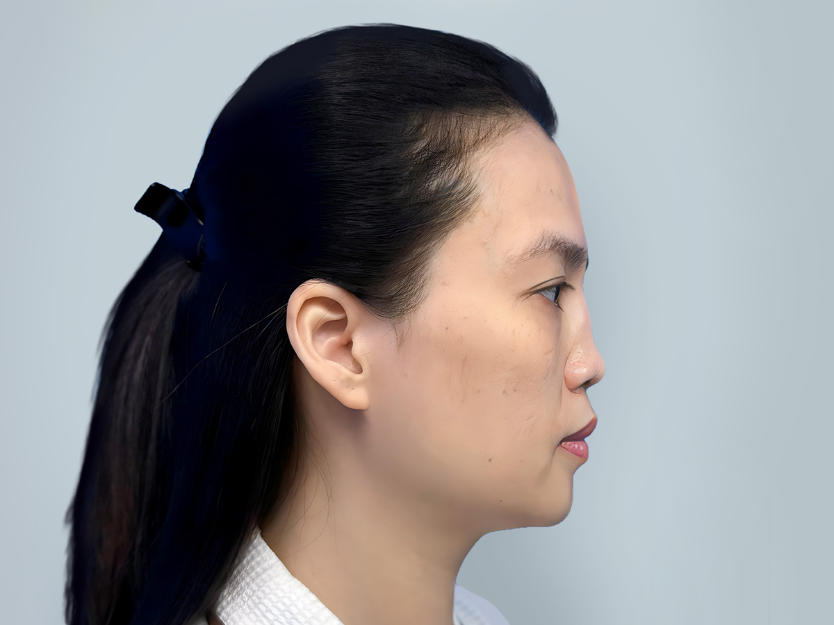 Cận cảnh cấu trúc mũi hỏng với nhiều mô sẹo xơ khiến kỹ thuật nâng mũi sửa lại trở nên phức tạp.