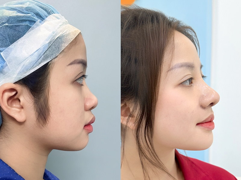 Khách hàng trước và sau khi nâng mũi, gương mặt sắc nét hơn đáng kể