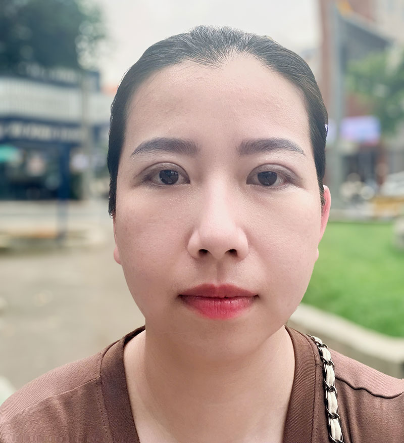 Sau 5 ngày cắt mí, đôi mắt của Thủy đã bớt sưng