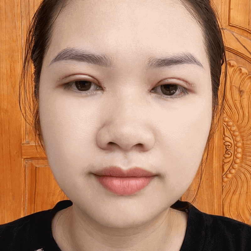 Sau cắt mí vài ngày mắt đã bớt sưng