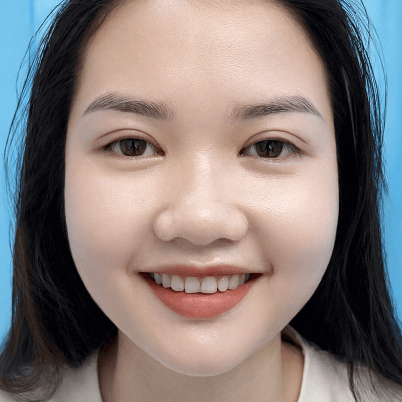 Sau khi cắt chỉ mí mắt đã tự nhiên hơn