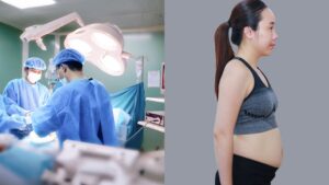 Ai nên hút mỡ và ai không nên? Điều kiện an toàn và chỉ số BMI bắt buộc 2026