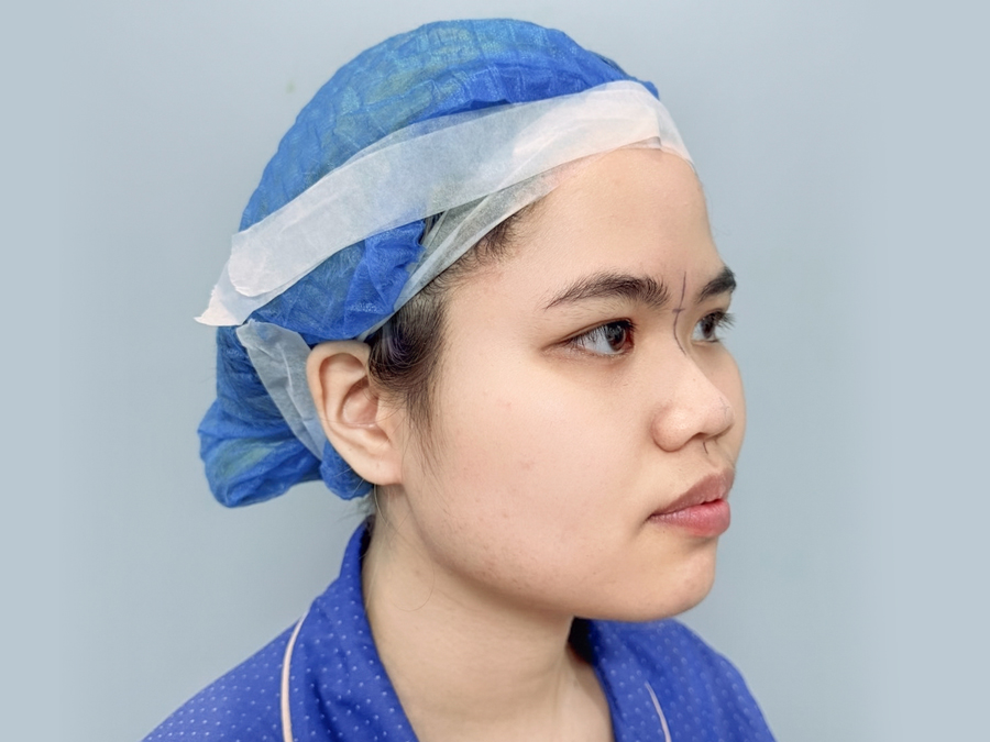 Mũi có khuyết điểm nên can thiệp nâng mũi