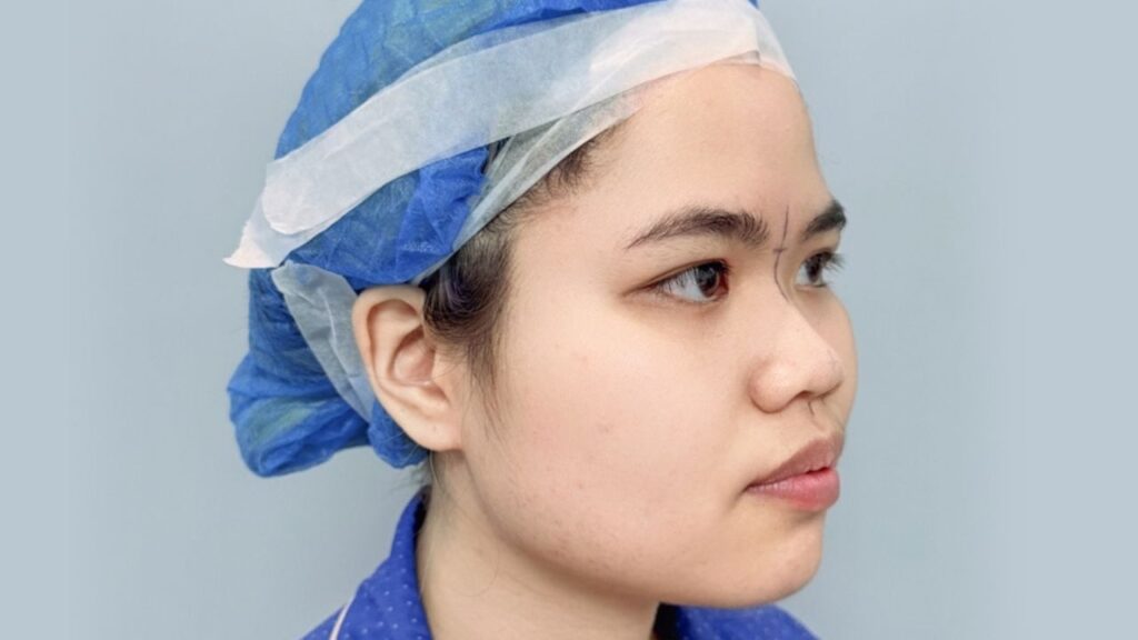 7 Nhóm đối tượng nên và không nên nâng mũi: Cảnh báo an toàn từ Bác sĩ