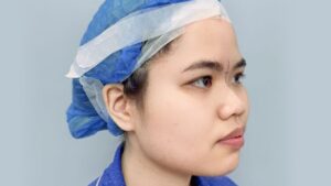 7 Nhóm đối tượng nên và không nên nâng mũi: Cảnh báo an toàn từ Bác sĩ