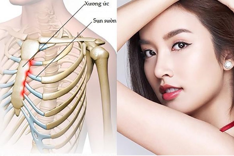 Sụn sườn được đánh giá là loại sụn nâng mũi tốt nhất khi nâng mũi sửa lại cho khách hàng hiện nay