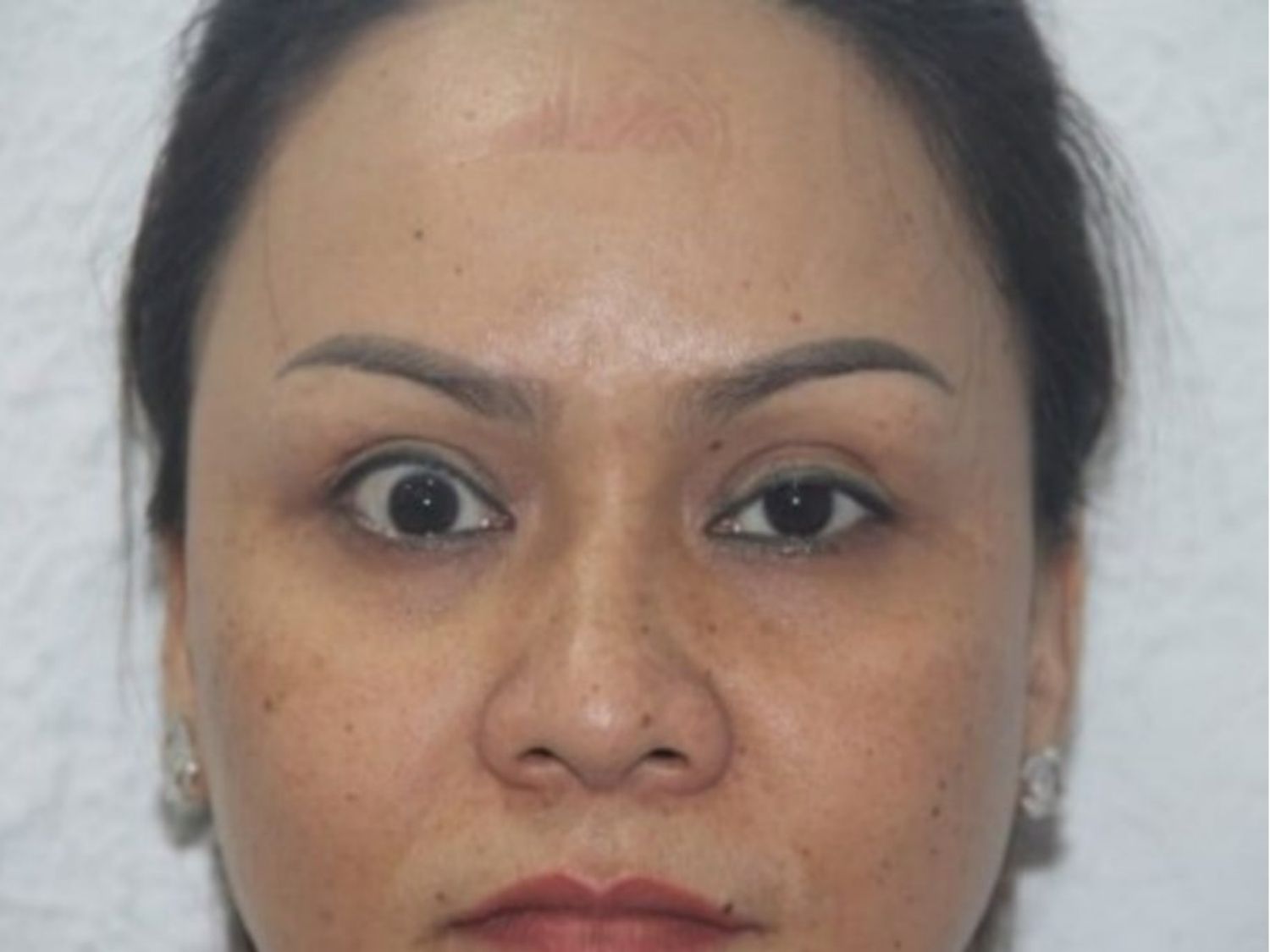 tình trạng mí mắt trợn sau cắt mí, đây là biến chứng khá nguy hiểm và cần được thăm khám sớm để khắc phục