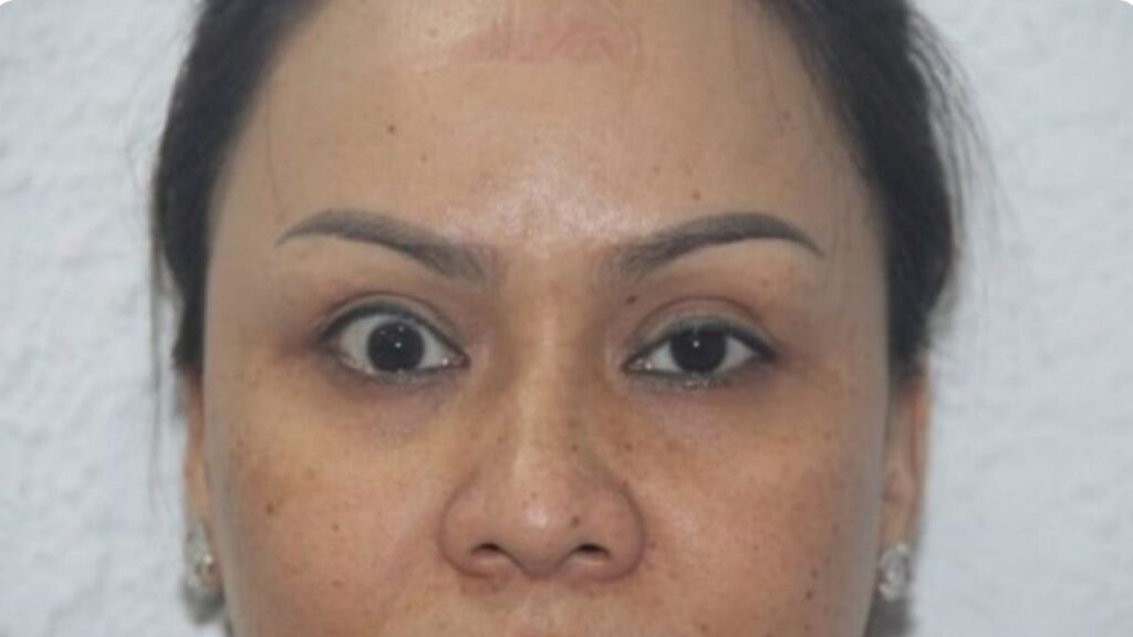 Biến chứng cắt mí: 12 dấu hiệu nhận biết & Cách xử lý an toàn từ Chuyên gia