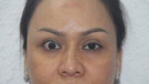 Biến chứng cắt mí: 12 dấu hiệu nhận biết & Cách xử lý an toàn từ Chuyên gia