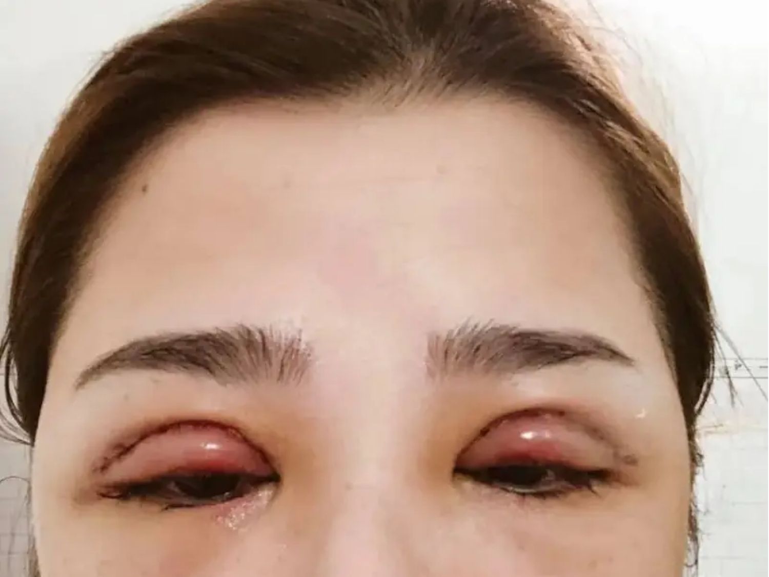 biến chứng sau cắt mí bị sưng nề, đau rát và ảnh hưởng đến tầm nhìn