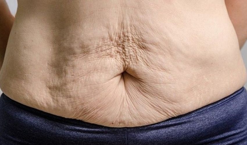 Tụ dịch sau hút mỡ là biến chứng thường gặp khiến vùng da bụng sau hút dễ nhiễm trùng, nhăn nheo và không săn chắc