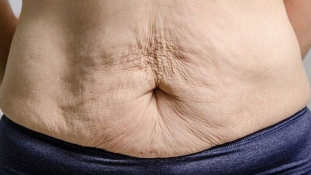 Biến chứng sau hút mỡ – Cách nhận biết tụ dịch, xơ cứng và quy trình xử lý tại Bệnh viện