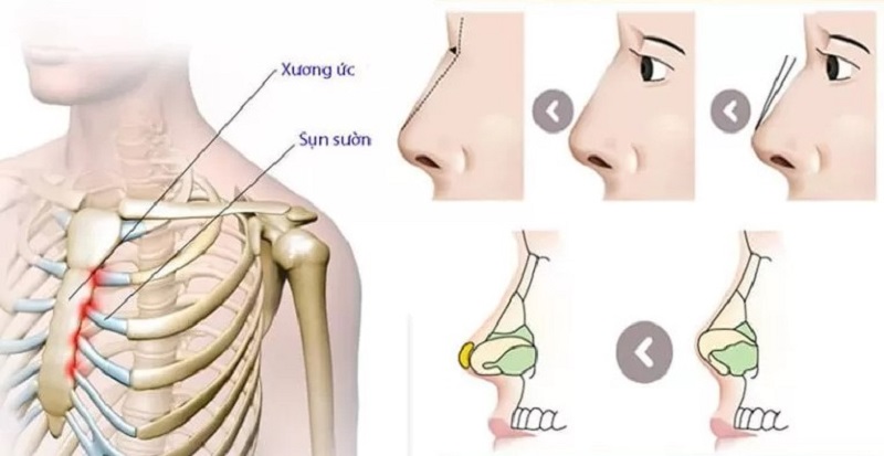 Các vị trí lấy sụn tự thân phổ biến trong nâng mũi như sụn vành tai sụn vách ngăn và sụn sườn giúp tương thích 100% với cơ thể