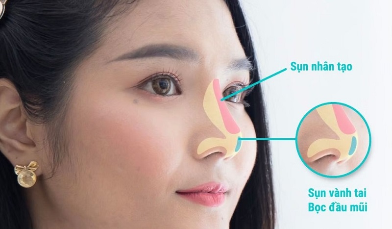 3 nhóm sụn nâng mũi chính bao gồm sụn tự thân sụn nhân tạo và sụn sinh học hỗ trợ