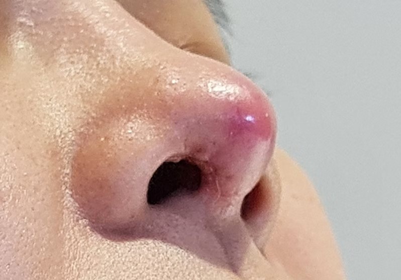 Biến chứng thường gặp khi chọn sai loại sụn nâng mũi gây tình trạng lộ sóng và đào thải sụn