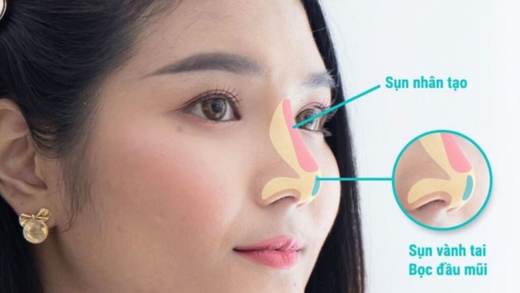 Các loại sụn nâng mũi phổ biến: Review 3 nhóm sụn & Cách chọn loại nào tốt nhất?