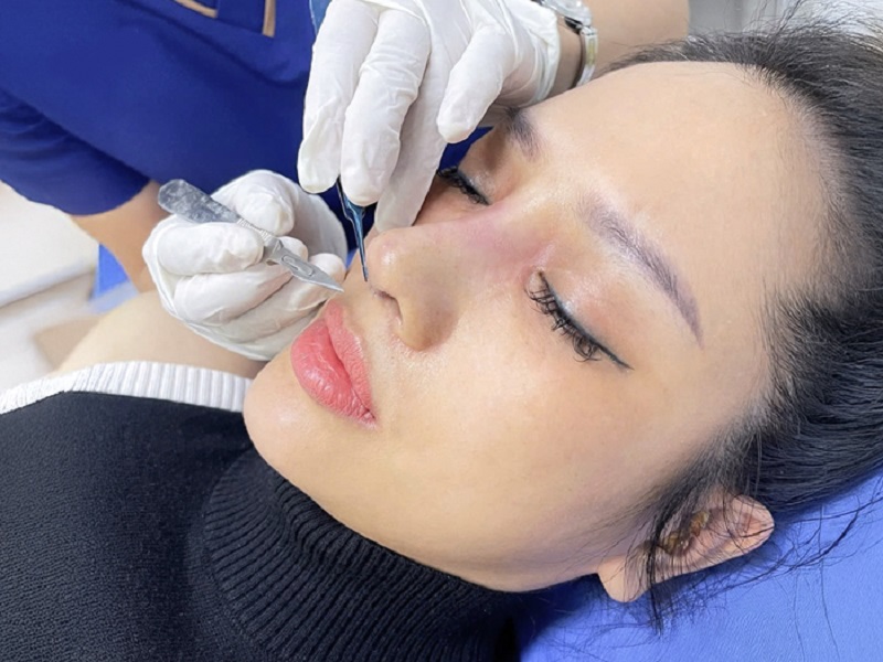 Khách hàng được cắt chỉ nâng mũi sau 7 ngày
