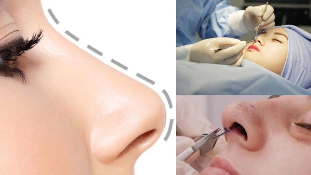 Cắt chỉ nâng mũi khi nào? Cắt ngày thứ mấy, có đau không và những lưu ý bắt buộc phải biết