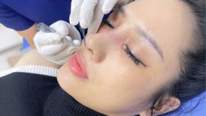 Cắt chỉ nâng mũi khi nào? Cắt ngày thứ mấy, có đau không và những lưu ý bắt buộc phải biết