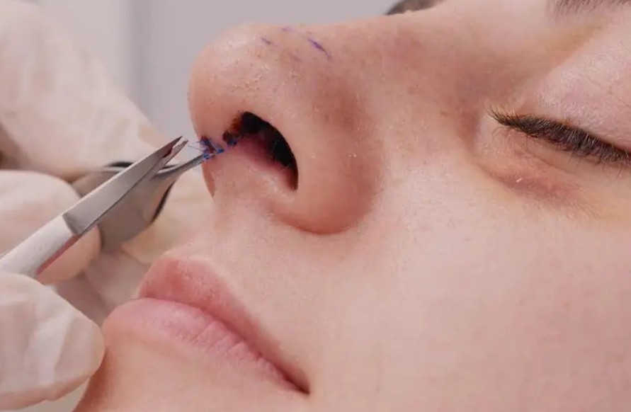 Cắt chỉ nâng mũi giúp mũi vết thương khép miệng hoàn toàn và hạn chế sẹo sau nâng