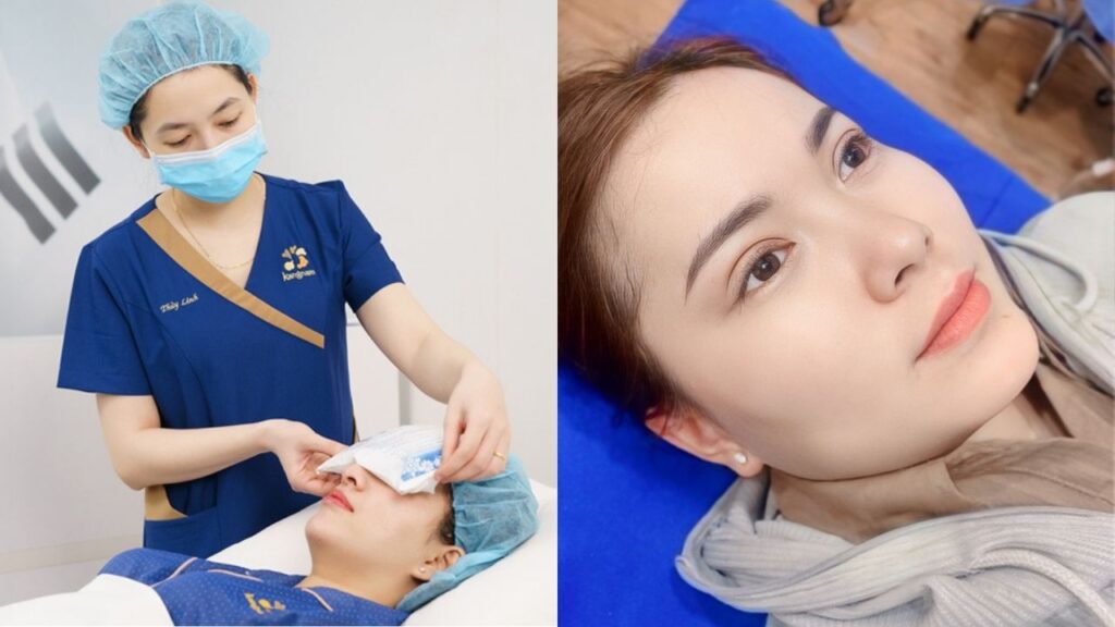 Cắt mí bao lâu hết sưng? Timeline phục hồi và 5 mẹo giảm sưng thần tốc